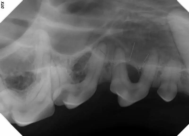 Right upper side showing the bony defect around 106, which had a grade 3 furcation exposure.