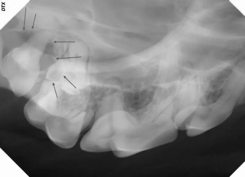 Right upper side, showing bone loss around 109 and 110. 110 had only Grade 1 (slight) mobility despite only having only a small amount of bone remaining around just one of the three roots.