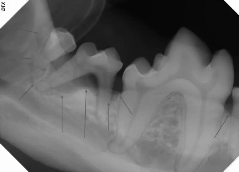 Right lower side, showing dramatic bone loss around 409, 410 and 411. No mobility was present around any of these teeth. Take another look at the pictured of this area above.