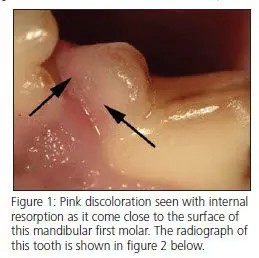 canine Tooth Resorption