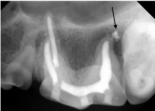 Final X-ray after dog root canal therapy.