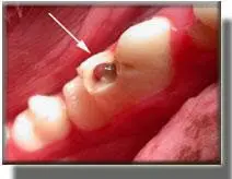 complicated dog tooth fracture with pulp exposure
