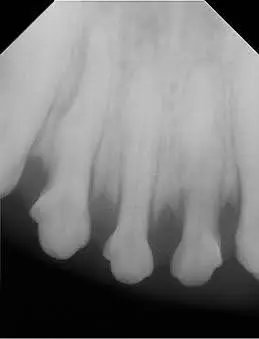 x-ray of tooth resorption