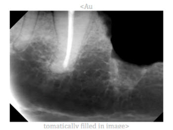 Figure 8. Final radiograph, showing the root canal completely filled to the apex of the root. 