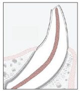 Figure 1. Diagram of an ucomplicated pet tooth crown fracture.