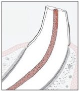 Diagram of a complicated pet crown fracture
