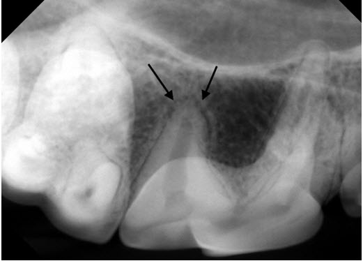 Normal Appearance of Periodontal Ligament Space in Dog
