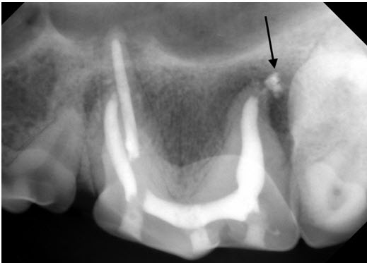 Final X-ray after dog root canal therapy.