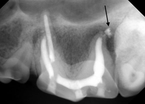 X-Ray After Pet Root Canal