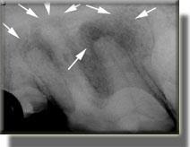 radiograph of damage to dog tooth from infection